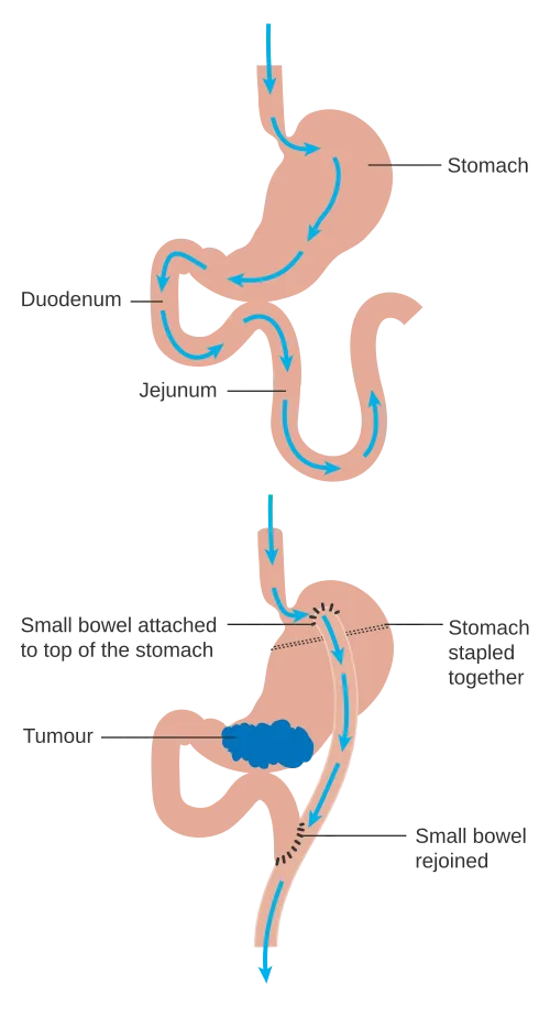 Telogen Effluvium After Bariatric Surgery: What 5-Year Data Reveals