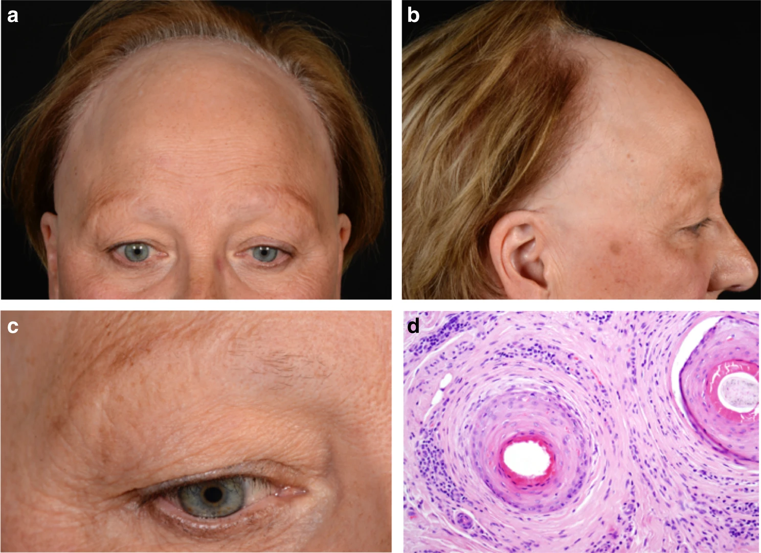 Frontal Fibrosing Alopecia: The Mysterious Epidemic Affecting Postmenopausal Women
