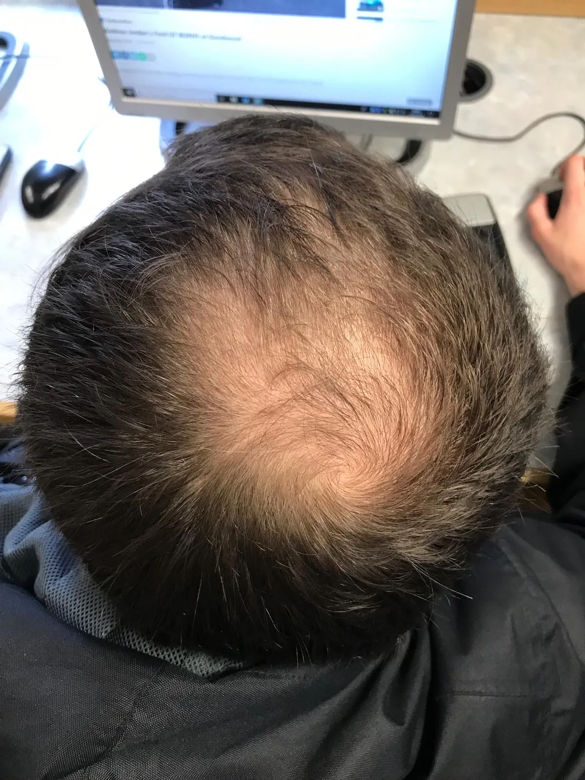 Hair Loss in Asian Patients: Why Standard Norwood Assumptions Don't Always Apply
