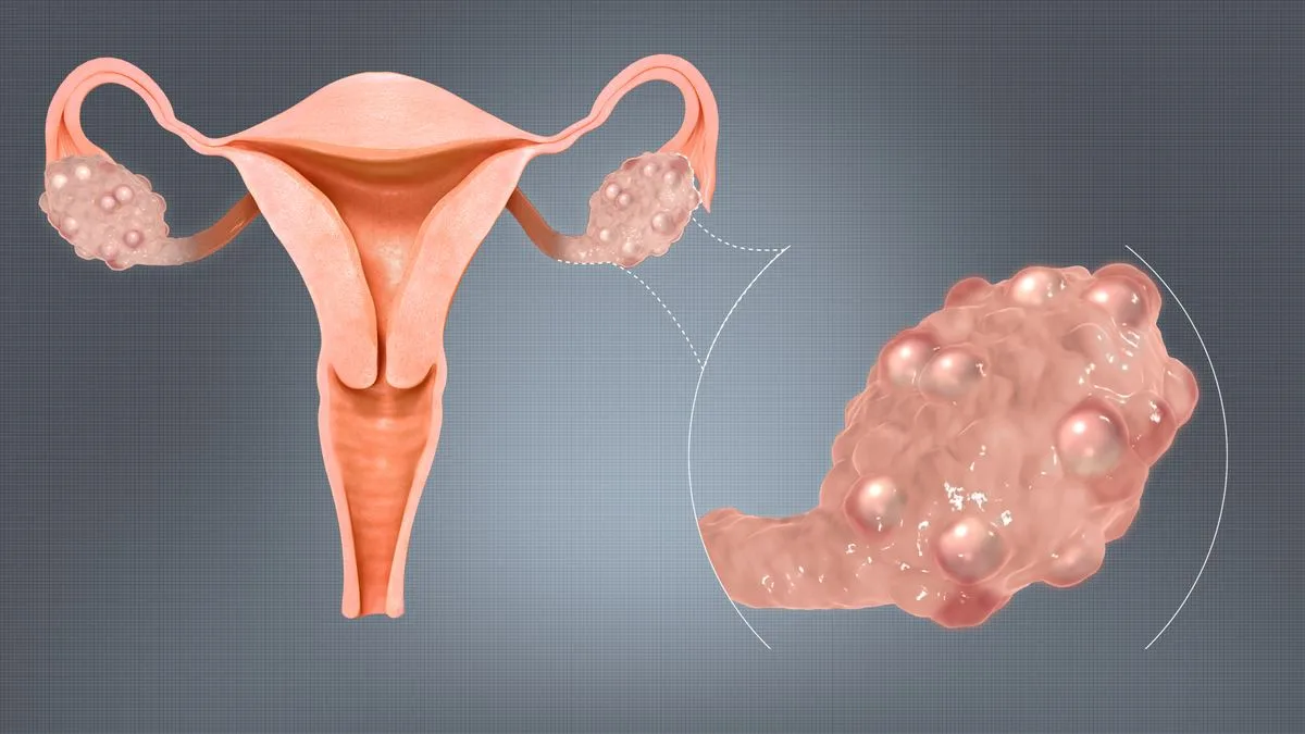 PCOS and Hair Loss: Treatment Considerations for the Underlying Endocrinology