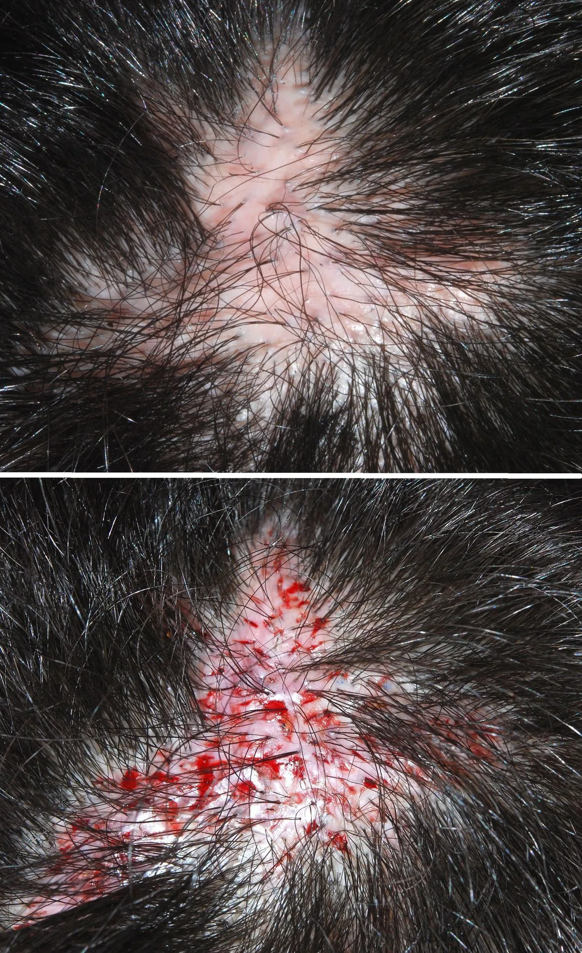 Robotic Hair Transplantation in 2025: What the Outcome Data Says About When It's Worth It