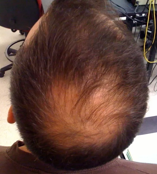 Traction Alopecia: Prevention Matters Because Treatment Doesn't Work Well