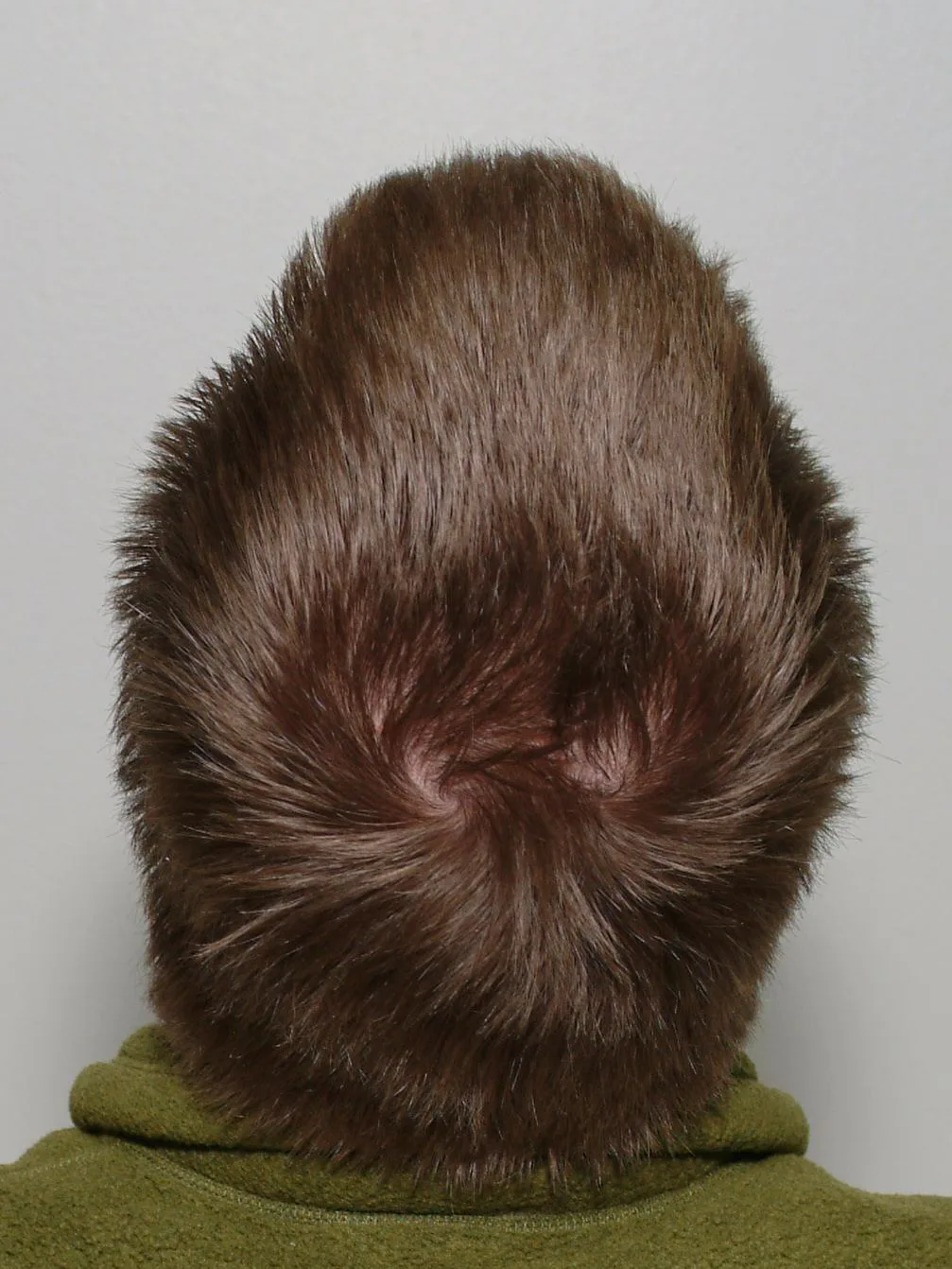Trichodynia: The Scalp Pain Some Hair Loss Patients Experience
