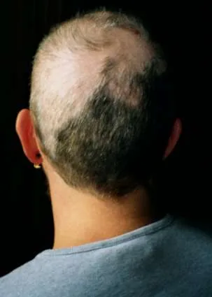 Trichotillomania: Hair Loss From an Underrecognised Mental Health Condition