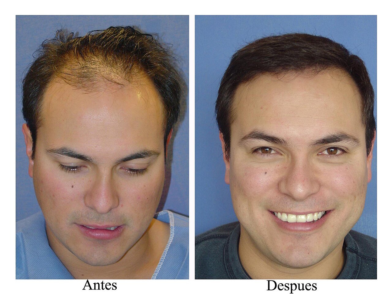 3D‑Printed Skin Grafts That Grow Real Hair Are Getting Closer to Use