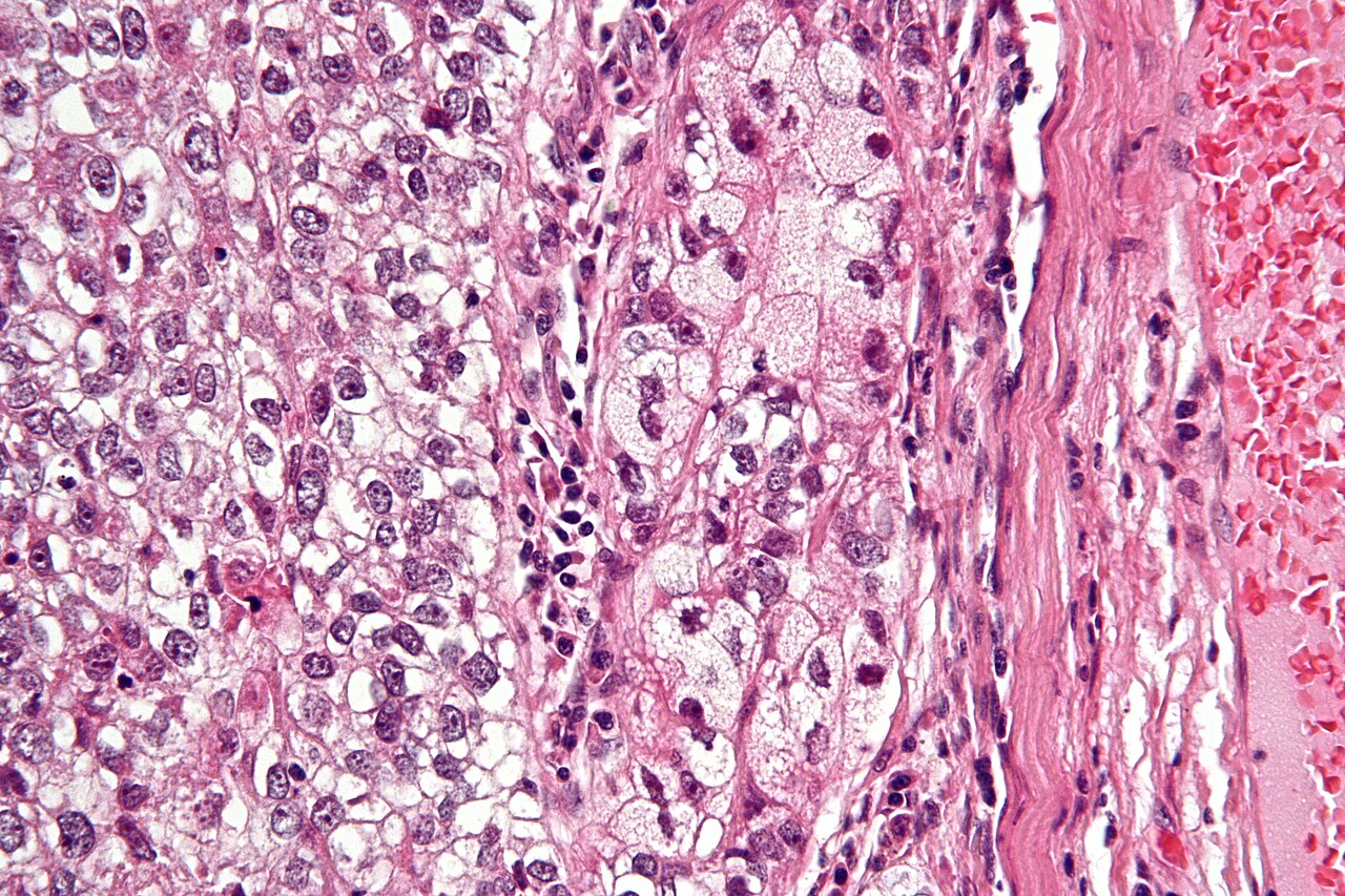 Very high magnification micrograph of a sebaceous carcinoma metastatic to the parotid gland . H&E stain . Related images Intermed. mag. High mag. Very high mag.