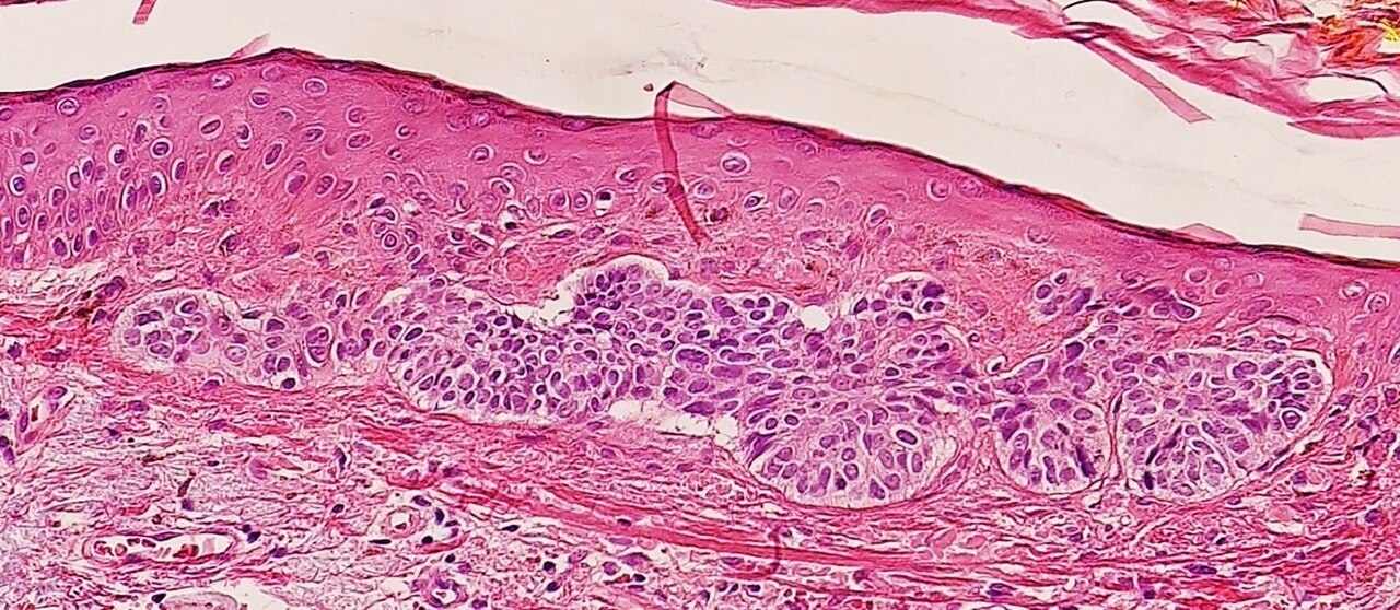 Superficial hair follicle tissue, which has resemblance superficial basal-cell carcinoma.