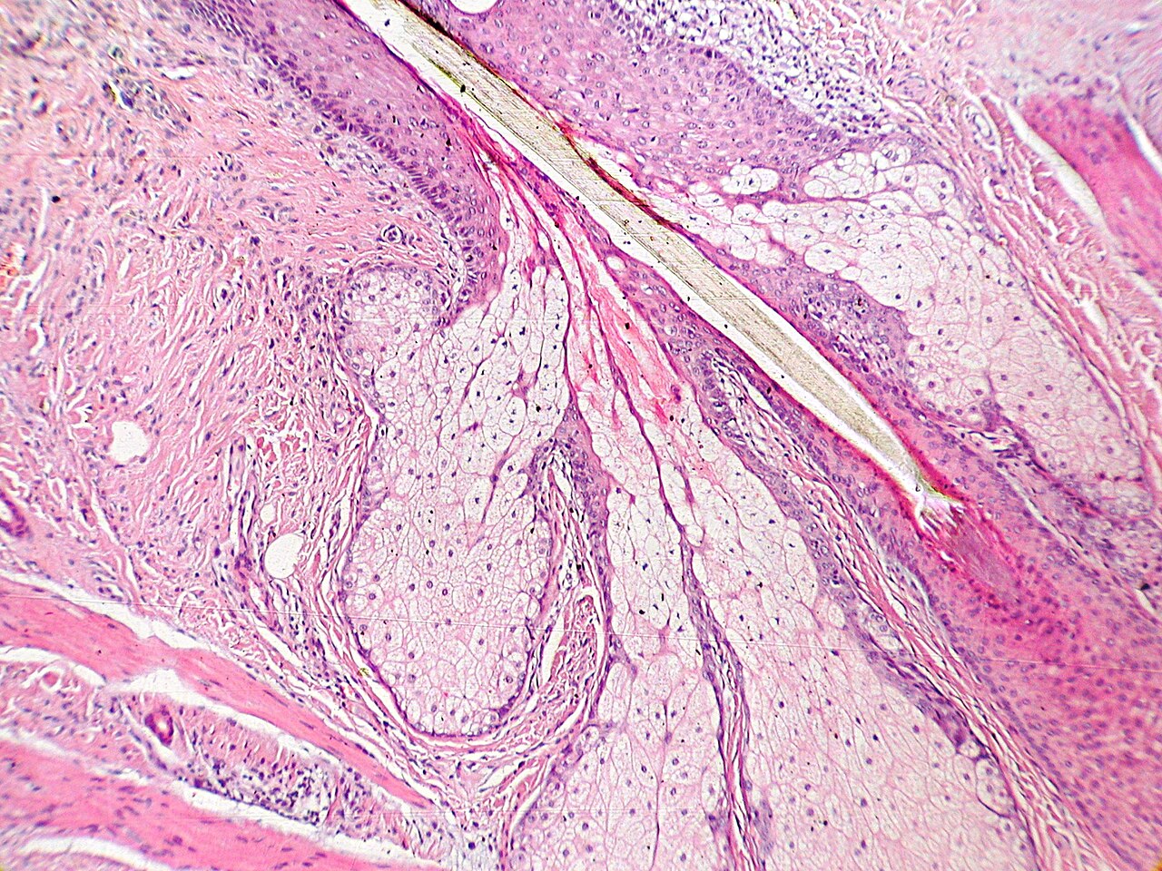 This is a hematoxylin and eosin stained slide at 10x of the insertion of sebaceous glands into hair shaft in a full, normal pilosebaceous unit, sectioned from tissue also found to have a benign intradermal nevus.