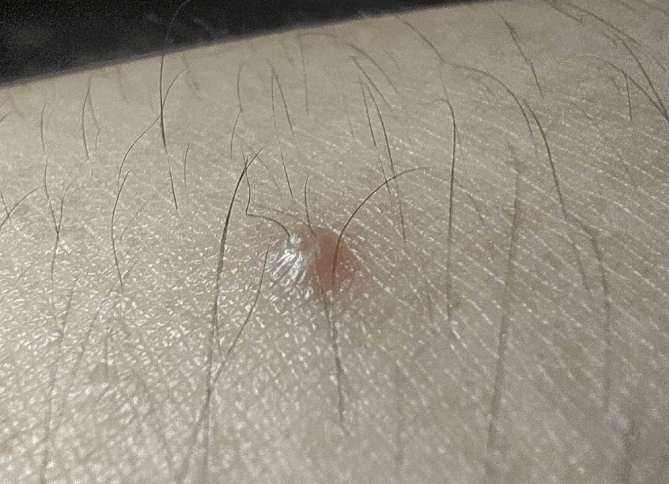 COVID-19 Hair Loss Three Years On: What the Long-Term Data Tells Us