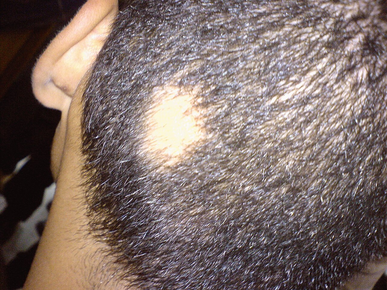 Alopecia areata.