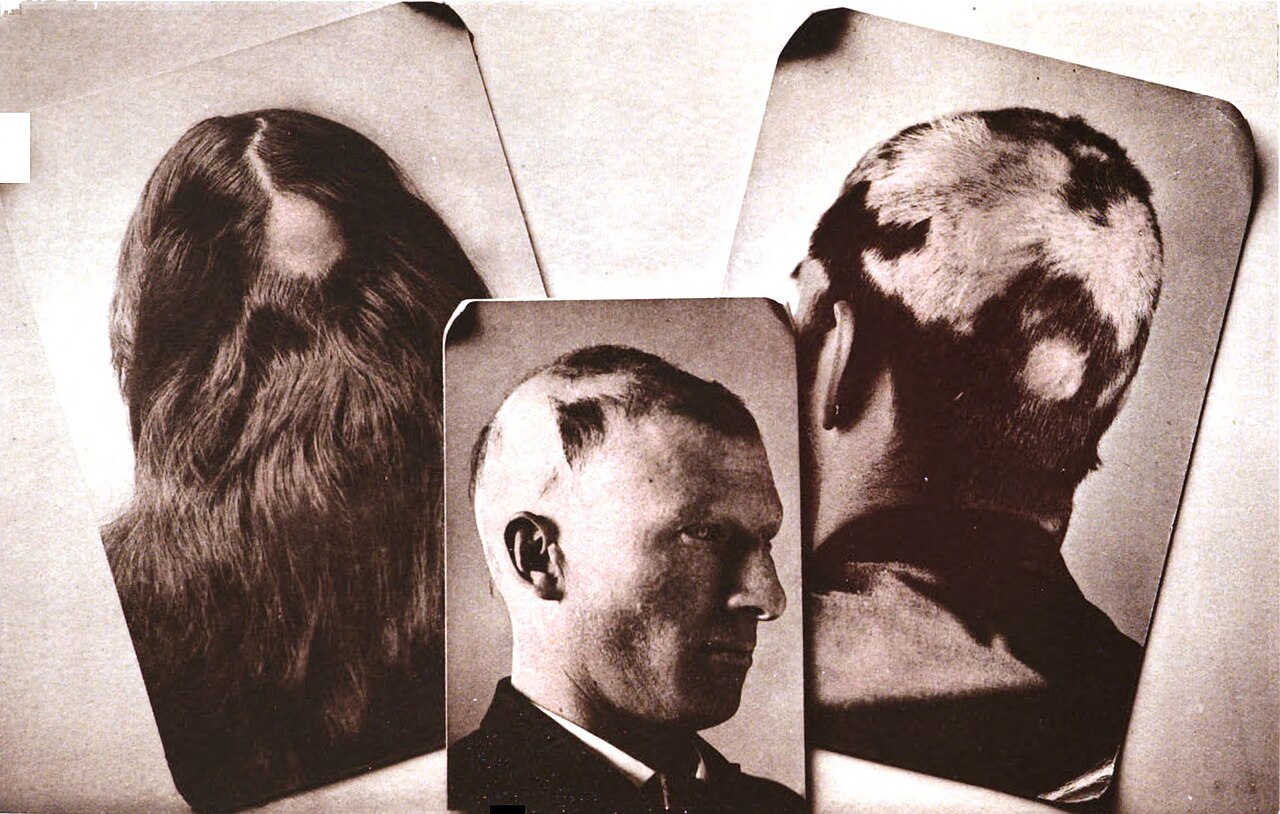Alopecia areata