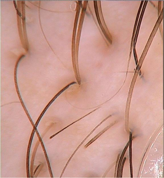 Frontal fibrosing alopecia: the international expert consensus on how to treat it