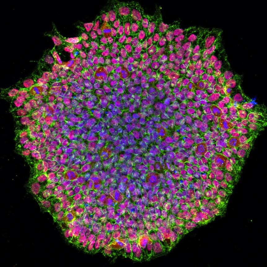 Researchers at NIH's National Eye Institute (NEI) developed the first patient-derived stem cell model for studying eye conditions related to oculocutaneous albinism (OCA). Learn more: at https://www.nih.gov/news-events/news-releases/nih-res