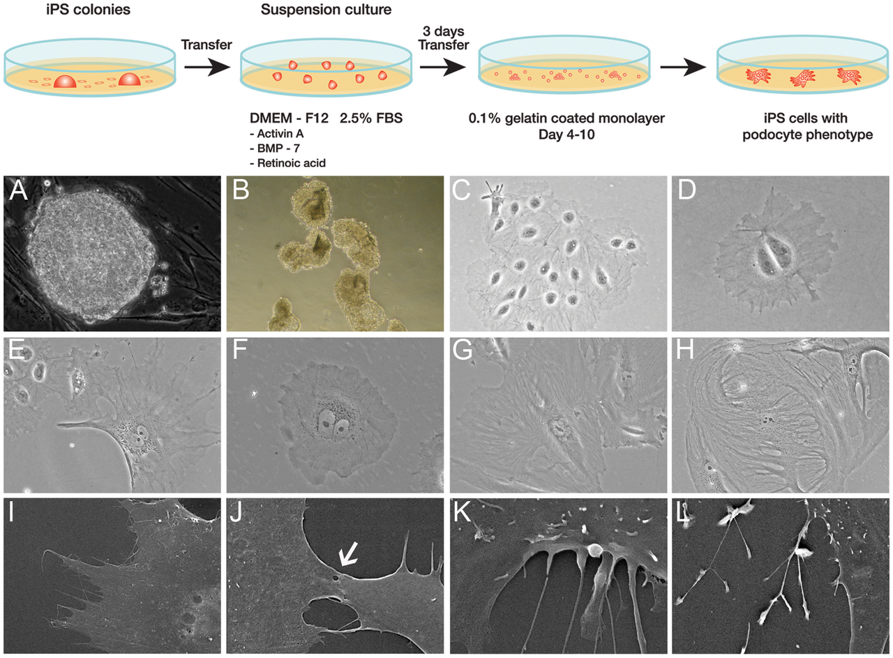 Figure 1. Podocyte Progenitors from induced pluripotent stem (iPS) cells. Diagrammatic depiction of the directed differentiation of iPS cells to podocyte progenitors (panel). A) iPS colonies derived from human kidney cells as assessed by ph