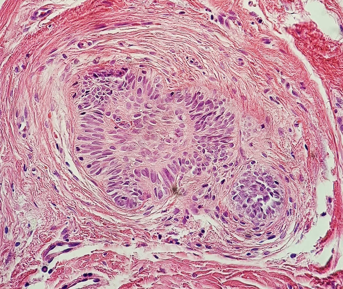 Histopathology of hair follicle periphery, potentially mimicking basal-cell carcinoma .