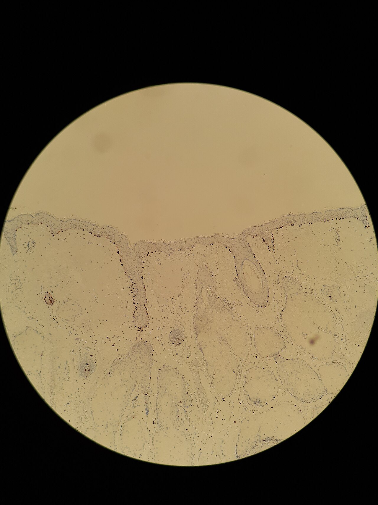 SOX10 immunohistochemistry of atypical melanocytic proliferation, seen mainly in hair follicles.
