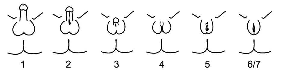 Schematic representation of the Quigley scale for grading androgen insensitivity syndrome . Grades 2 through 5 quantify four degrees of increasingly feminized genitalia that correspond to PAIS . Grades 1 and 6/7 correspond to MAIS and CAIS