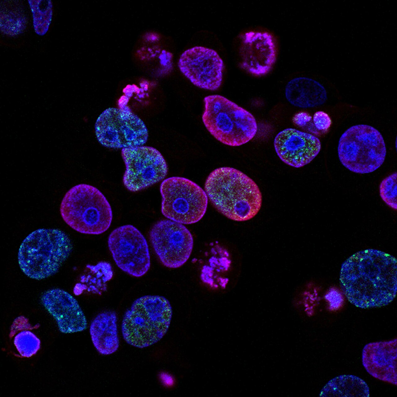 Human colorectal cancer cells treated with a topoisomerase inhibitor and an inhibitor of the protein kinase ATR (ataxia telangiectasia and Rad3 related), a drug combination under study as a cancer therapy. Cell nuclei are stained blue; the