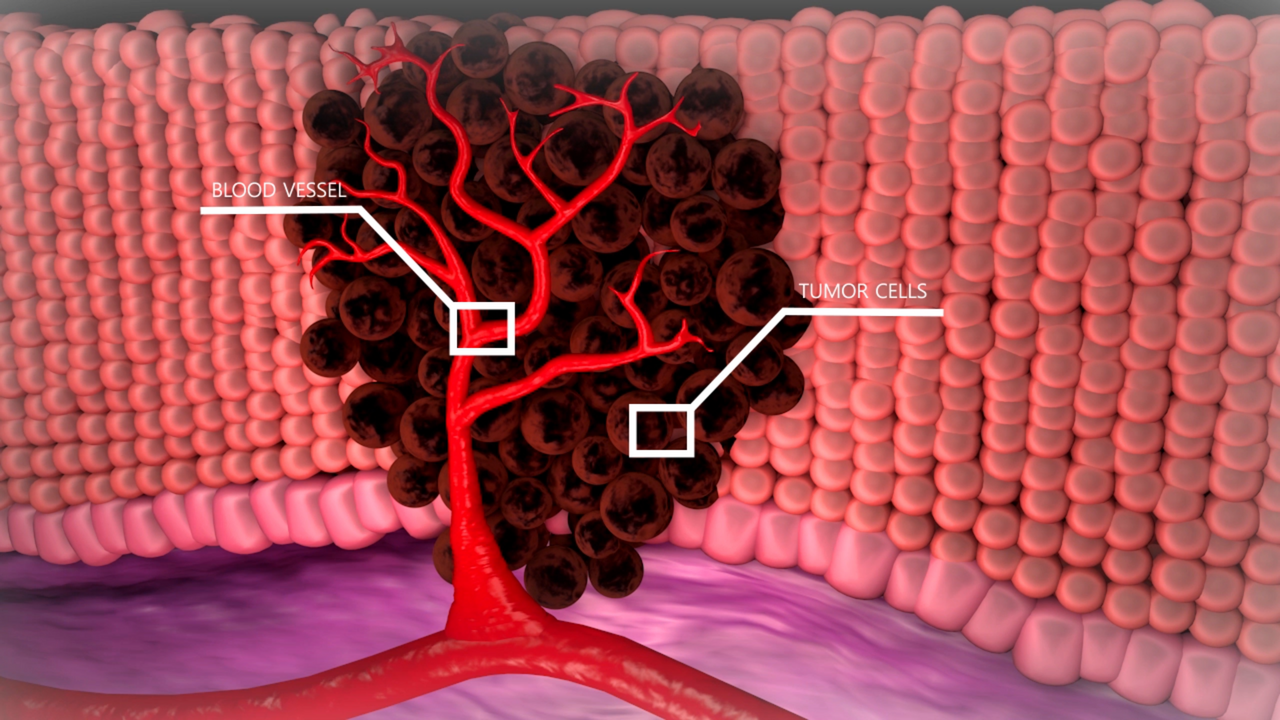 Tumor cells are created and with the help of the blood vessels, they feed themselves. These tumor cells are created in the skin.