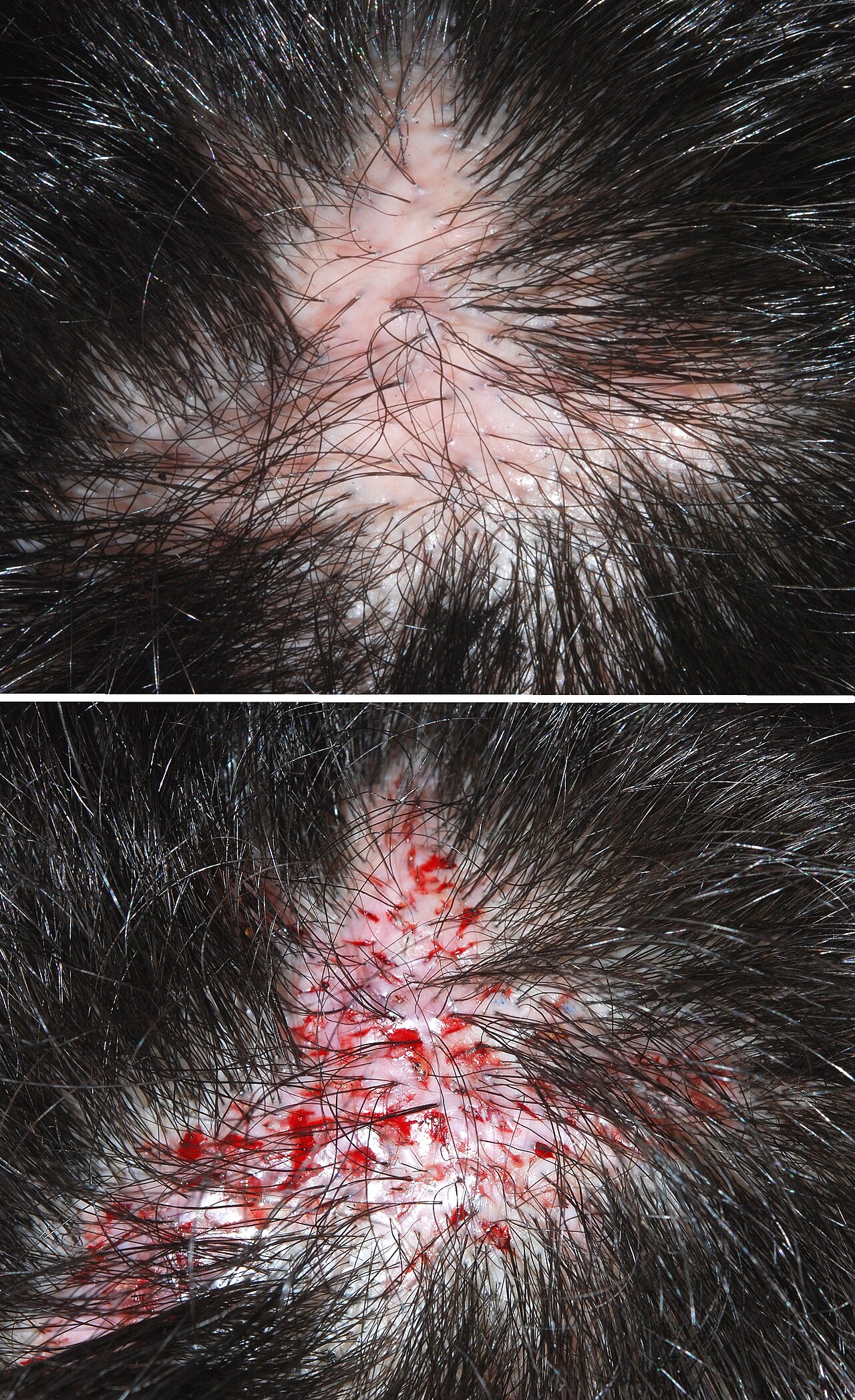 Hair transplantation before and after. Example of a bad graft transplant. (scar of a Hidradenitis suppurativa operation on the back of the head.)
